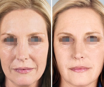 Dermal Fillers Treatment in Delhi, Dermal Fillers, dermal filler treatment, dermal fillers in delhi